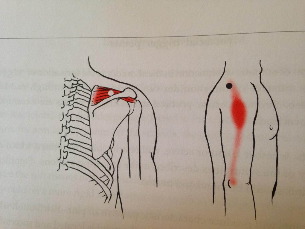 Supra Spinatus muscle showing trigger point and pain referral.
