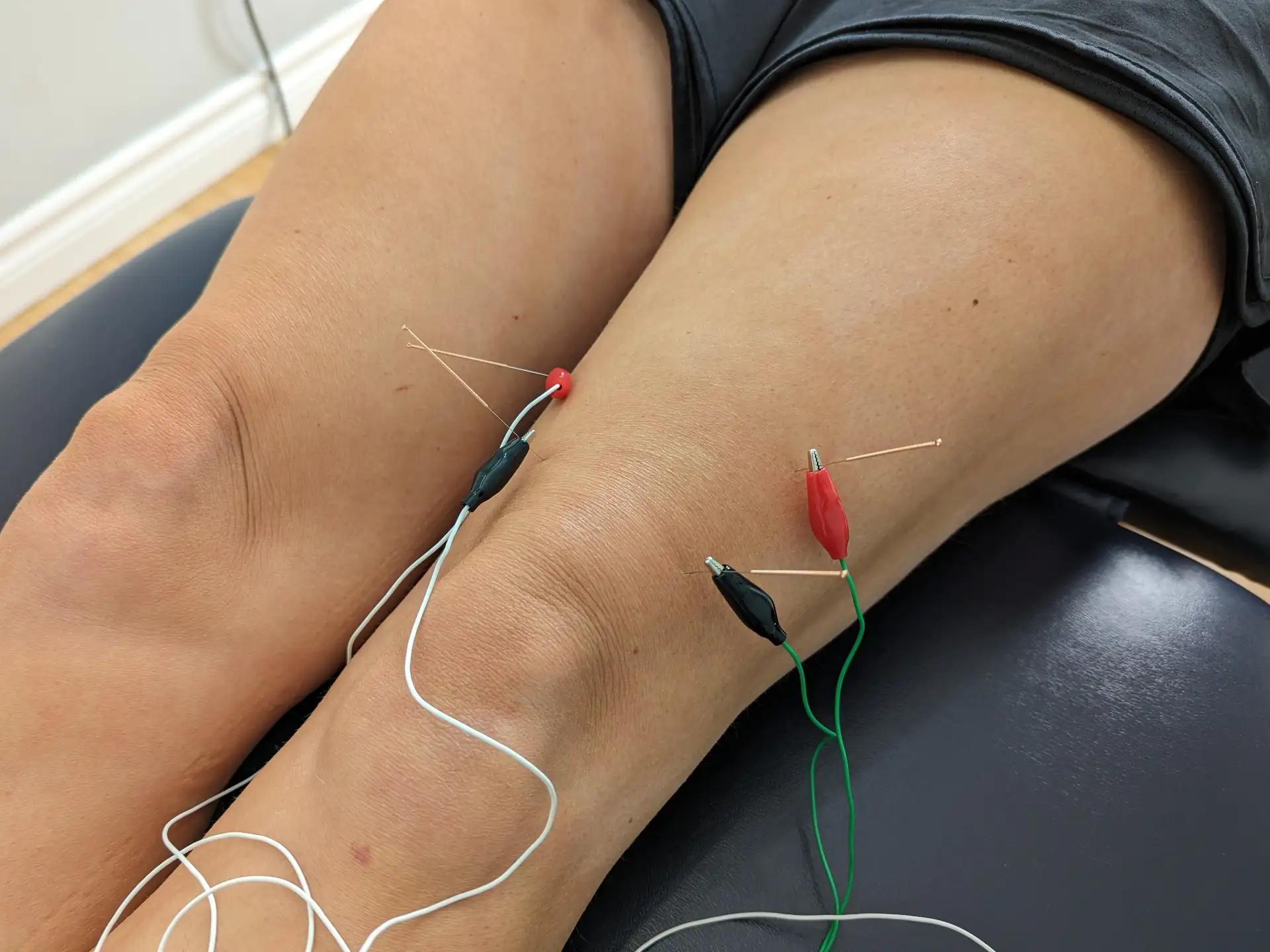 Acupuncture for arthritis and cartilage problems