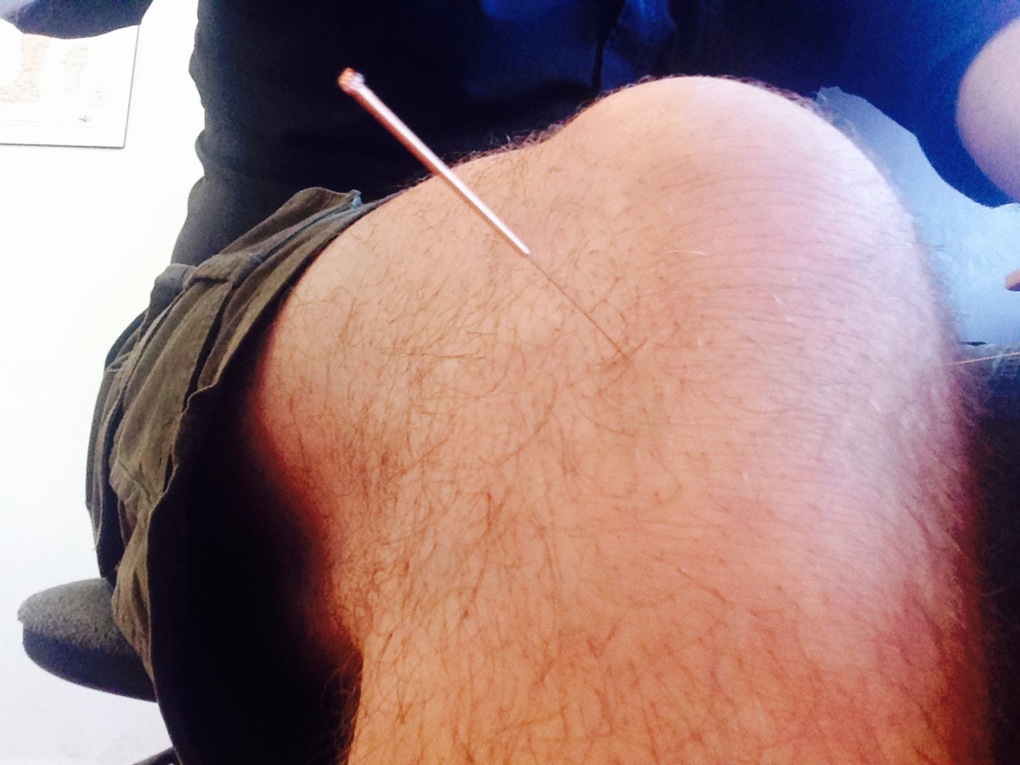 Acupuncture for arthritis and cartilage problems