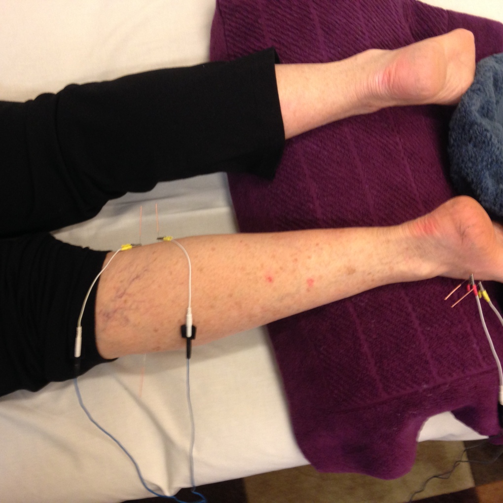Foot pain successfully treated using electro- acupuncture