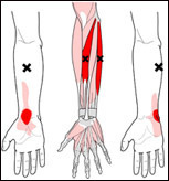Massage these trigger points X, to relieve Wrist Pain.